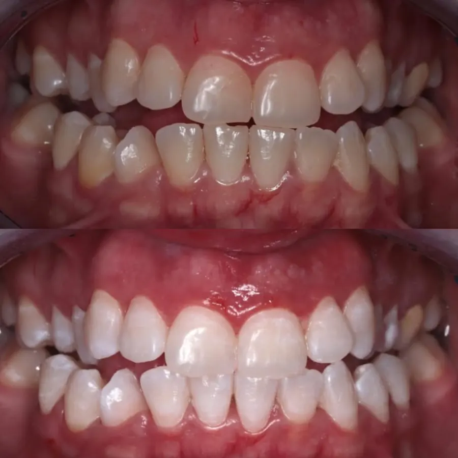 From yellow to bright white teeth in one visit