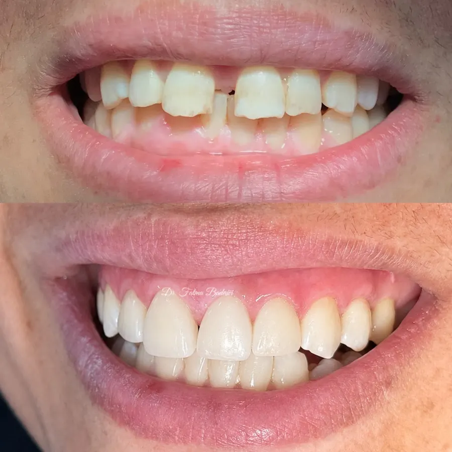 No-prep veneers