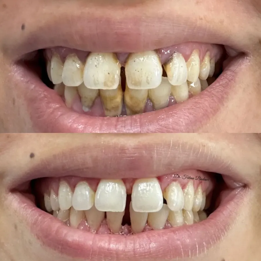 Deep scaling and polishing then laser whitening
