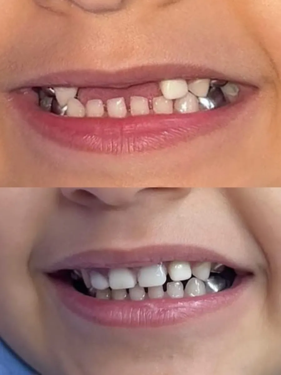 Replacing extracted front teeth in kids