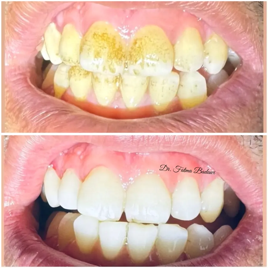 Deep scaling, polishing and stain removal