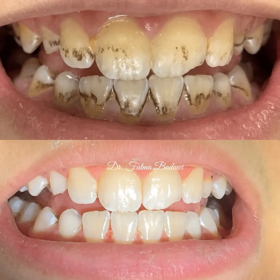 Removing stains from children's teeth