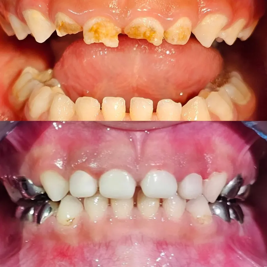 Treating cavities in children and restoring function and appearance