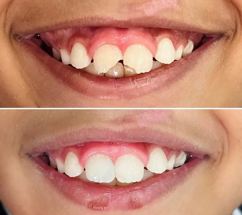 Restoring a child's chipped front teeth in one visit