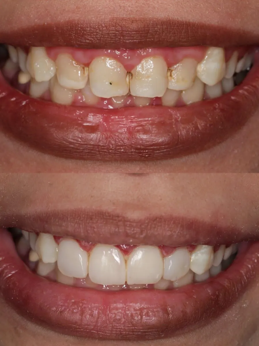 Teeth repairing of shape & shade