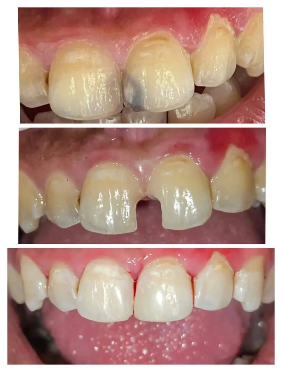 Selective caries removal and natural reshaping of a front tooth in one visit