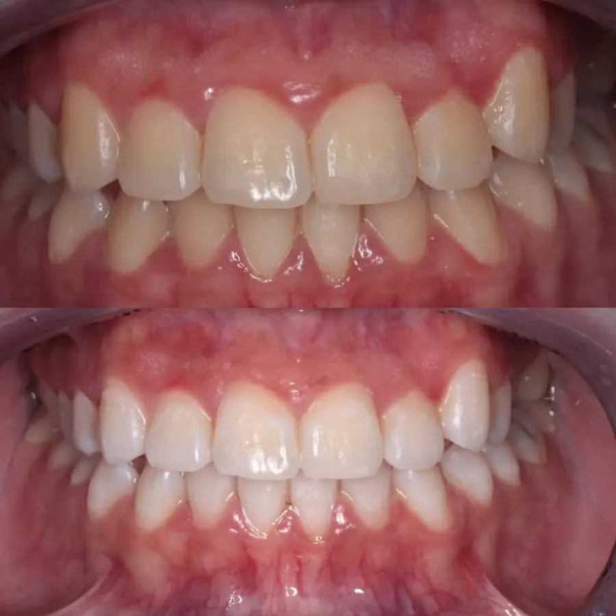 Teeth whitening with laser
